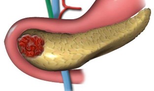 Pancreatitis thb_ILLab234